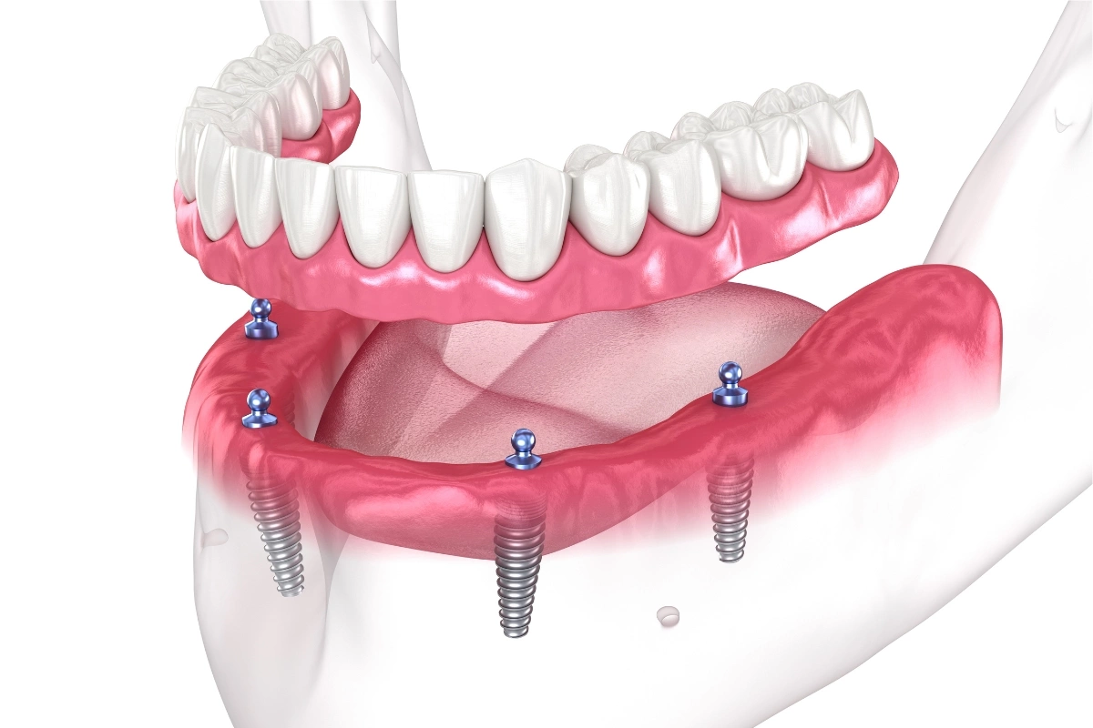 How Dental Implants Enhance Oral Health and Overall Well-being